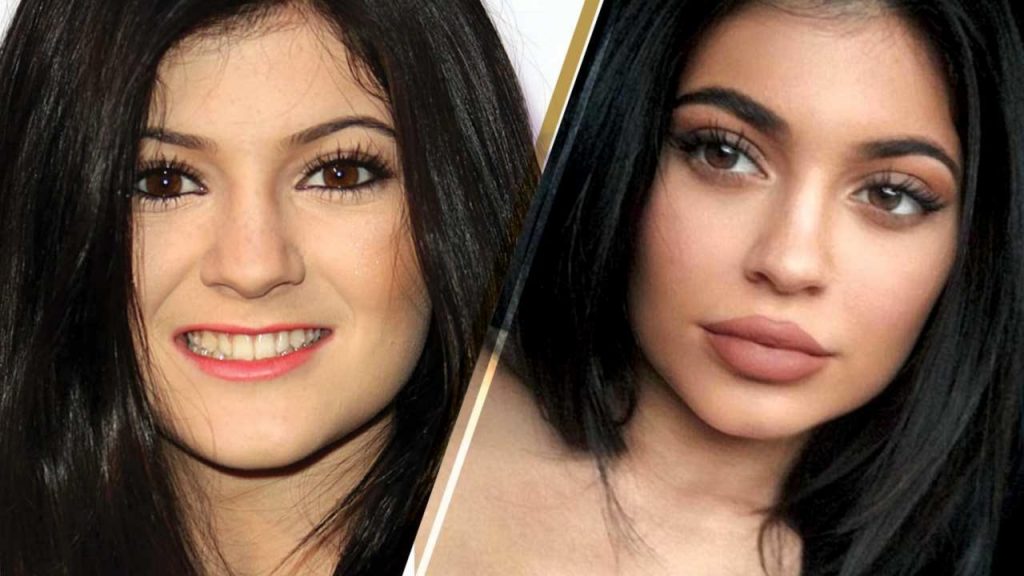 Kylie Jenner New & Old Face Side By Side Interviews